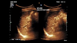 Splenic Calcifications  Ultrasound  Case 10 [upl. by Xonk488]