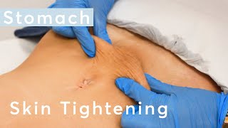 Skin Tightening Stomach  HIFU Ultraformer III Treatment [upl. by Sremlahc739]