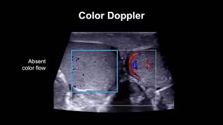 Diagnosing testicular torsion [upl. by Aizek560]