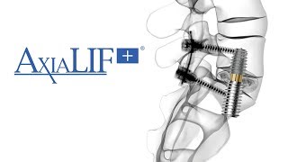 The AxiaLIF® L5S1 Spinal Fusion Procedure [upl. by Ariaes]