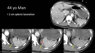 Blunt Abdominal Trauma Part 3 Splenic Injury short [upl. by Ahsilak]