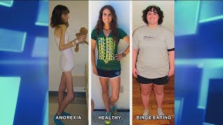 How an Anorexic Can Become a Binge Eater [upl. by Aikemal]