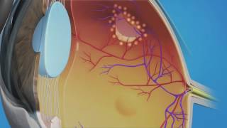 Prophylactic Laser Photocoagulation Laserpexy for Retinal Tear [upl. by Fakieh]