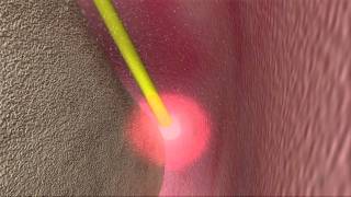 Laser Periodontal Therapy  WPT™ Animation [upl. by Chilt639]