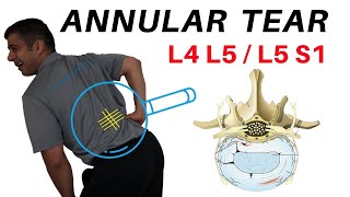 Annular Tear L4L5 L5S1 Disc Bulges [upl. by Bernadette]