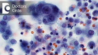 What is Cytopathology What are the different types of Cytology test  Dr Sanjeev Katti [upl. by Oiluarb772]