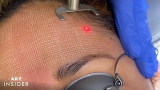 Minimize Acne Scarring With Laser Resurfacing [upl. by Licastro157]